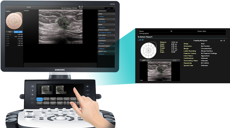 S-Detect for Breast