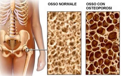 Cos’è l’osteoporosi?